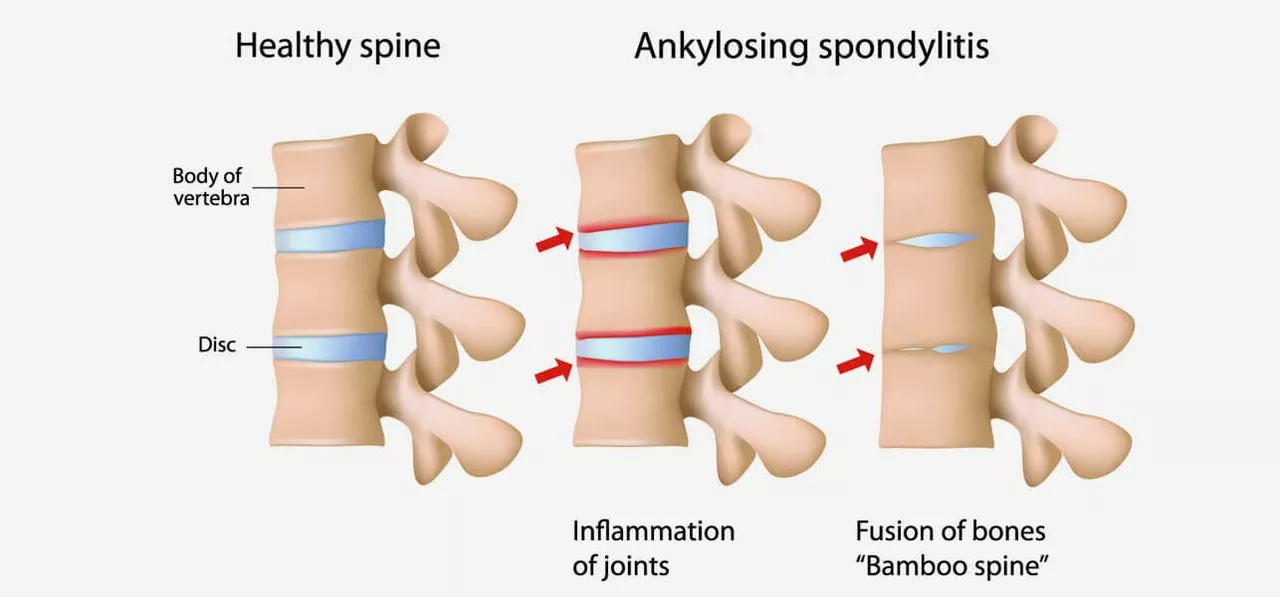 Sulfasalazine for Ankylosing Spondylitis: A Comprehensive Review