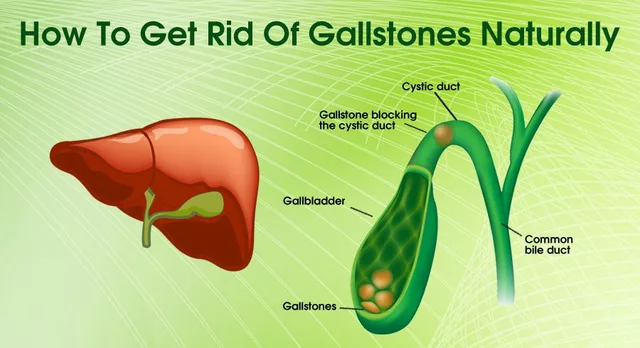 The Long-Term Effects of Living with Gallstones