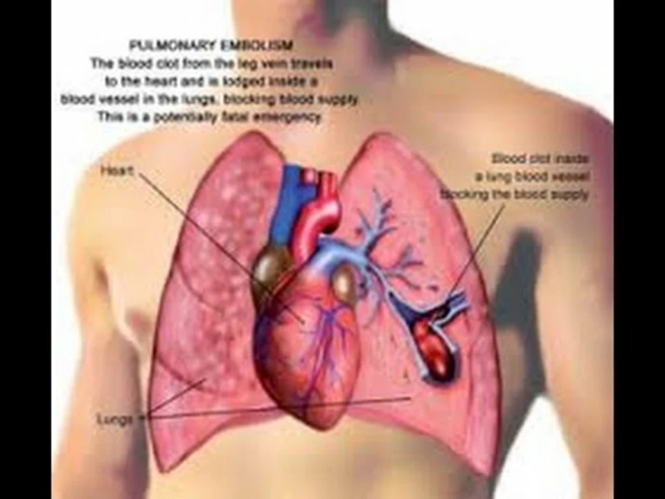 How Pulmonary Embolism Affects Your Heart and Lungs