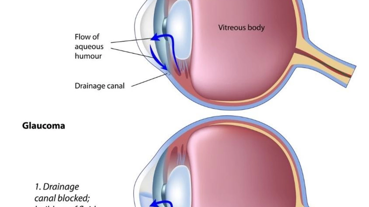 Cabergoline and Glaucoma: A Potential Treatment Option